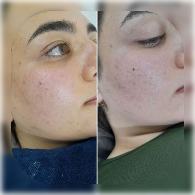 ابرسانی عمقی