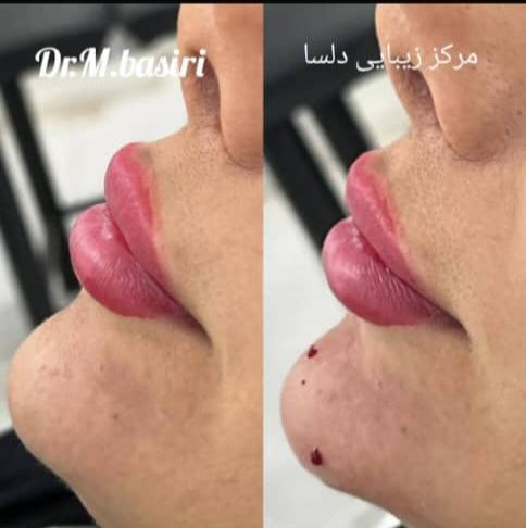 تزریق فیلر به چانه