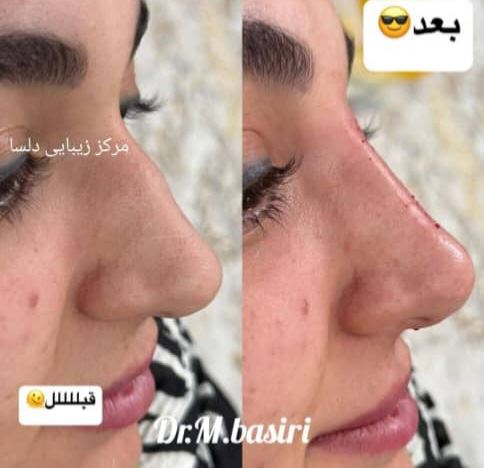 اصلاح فرم بینی