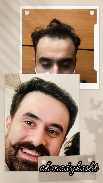 کاشت مو و ابرو تضمینی در غرب تهران