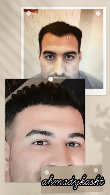 کاشت مو و ابرو تضمینی در غرب تهران