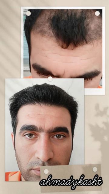 کاشت مو و ابرو ارزان در غرب تهران