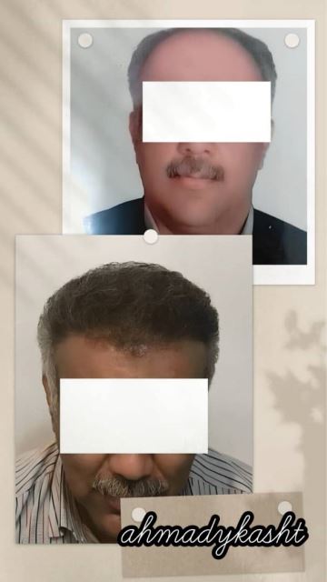 کاشت مو و ابرو تضمینی در غرب تهران