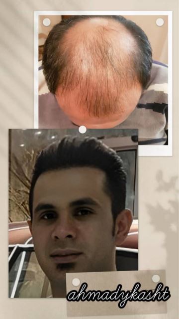 کاشت مو و ابرو تضمینی در غرب تهران