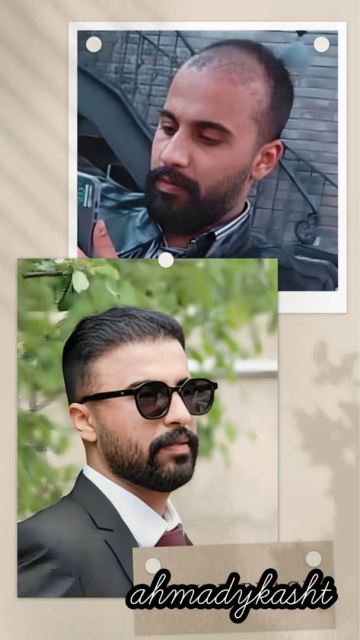 کاشت مو و ابرو تضمینی در غرب تهران