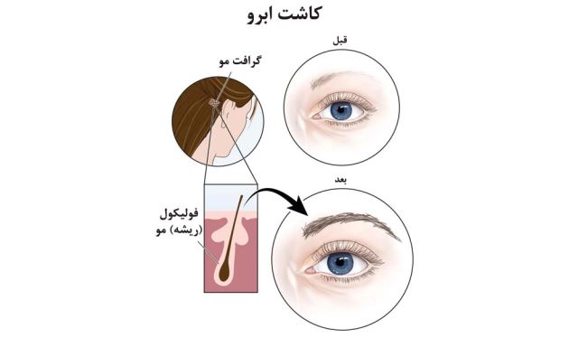 بهترین کلینیک کاشت مو در اردبیل