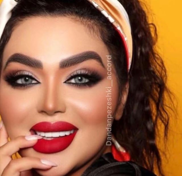 لیمینت سرامیکی