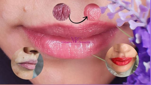 خدمات دارک لیپس (رفع تیرگی لب)😍