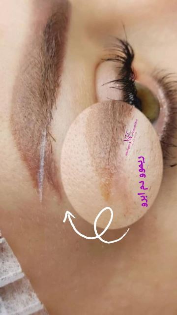 خدمات ریموو تک جلسه ای چند جلسه ای👌🏻