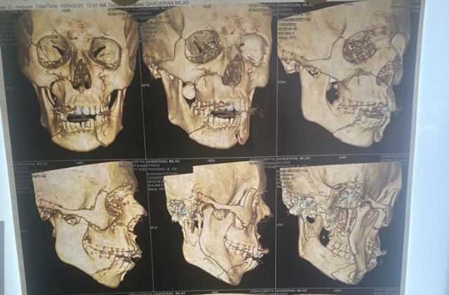 شکستگی متعدد صورت