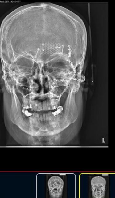 بازسازی شکستگی صورت