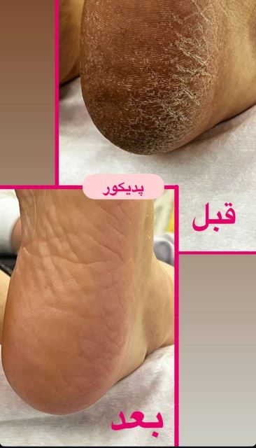خدمات پدیکور پا 😍برای دیدن نمونه کارهای بیشتر روی عکس کیلیک کنین☝🏻