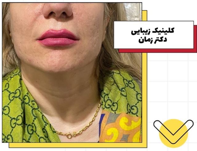 توصیه های بعد از تزریق ژل: