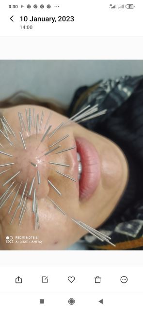 انجام طب سوزنی برای درمان وزیبایی