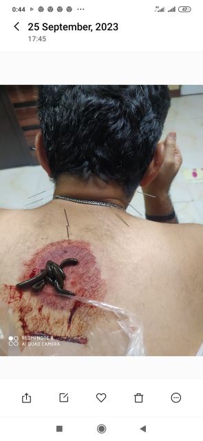 انجام طب سوزنی