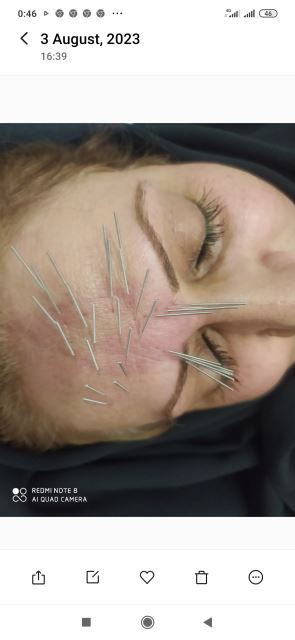 رفع خطوط پیشانی