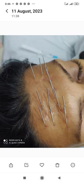 رفع چین وچروک پیشانی