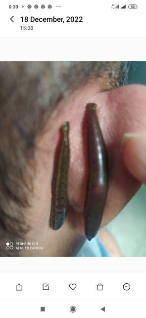 زالوگذاری برای درمان میگرن