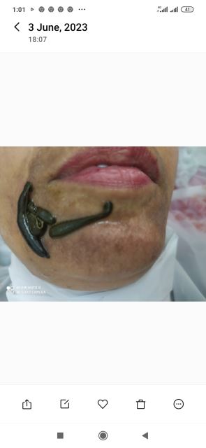 زالوگذاری برای درمان لک