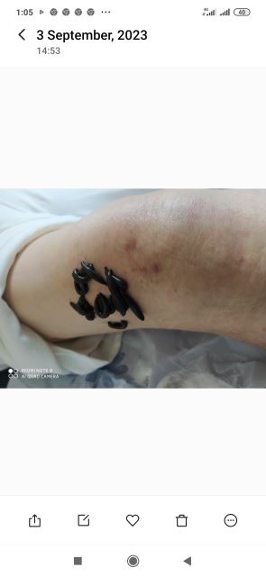 زالوگذاری روی زانو