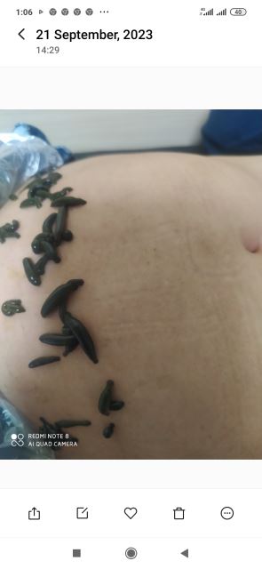 زالوگذاری زیرناف